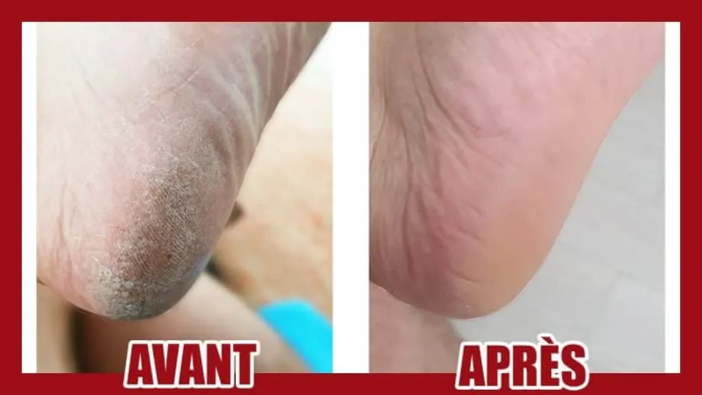 8 astuces naturelles contre la corne aux pieds secs et abîmés